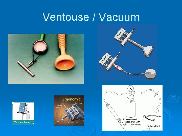 Ventouse / Vacuum 