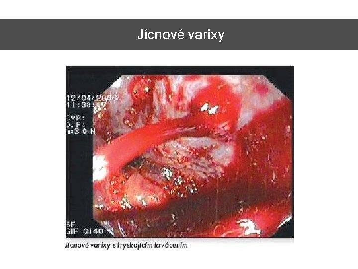 Jícnové varixy 