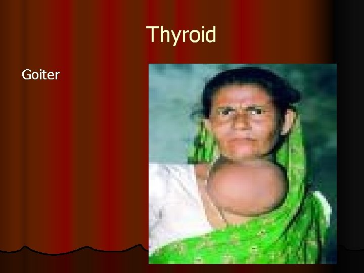 Thyroid Goiter Thyroid Goiter