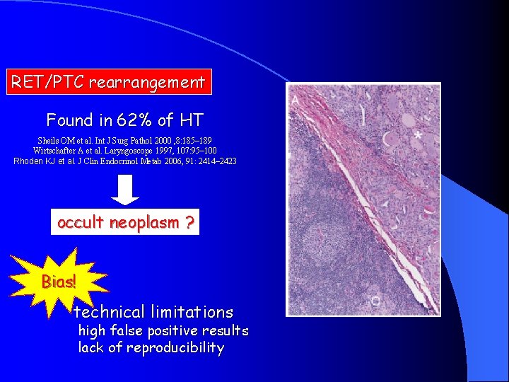 RET/PTC rearrangement Found in 62% of HT Sheils OM et al. Int J Surg