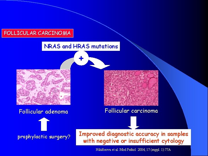 FOLLICULAR CARCINOMA NRAS and HRAS mutations + Follicular adenoma prophylactic surgery? Follicular carcinoma Improved