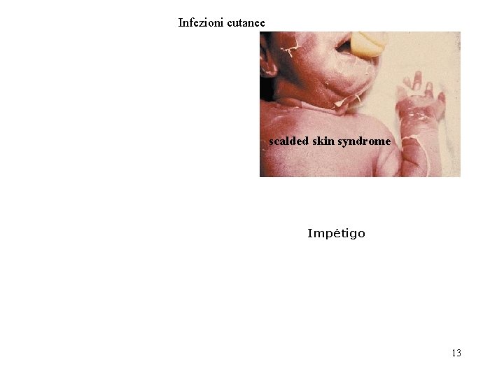 Infezioni cutanee scalded skin syndrome Impétigo 13 