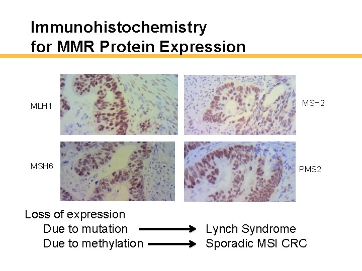 Immunohistochemistry for MMR Protein Expression MLH 1 MSH 6 Loss of expression Due to