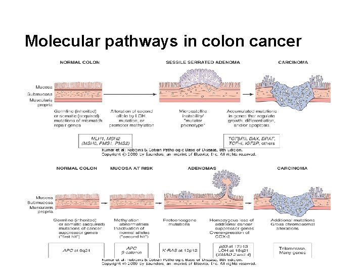 Molecular pathways in colon cancer 