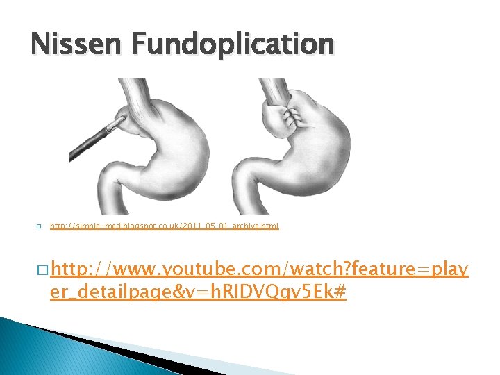 Nissen Fundoplication � http: //simple-med. blogspot. co. uk/2011_05_01_archive. html � http: //www. youtube. com/watch? Nissen Fundoplication � http: //simple-med. blogspot. co. uk/2011_05_01_archive. html � http: //www. youtube. com/watch?