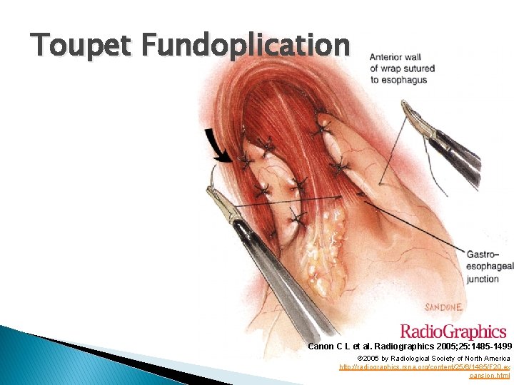 Toupet Fundoplication Canon C L et al. Radiographics 2005; 25: 1485 -1499 © 2005 Toupet Fundoplication Canon C L et al. Radiographics 2005; 25: 1485 -1499 © 2005