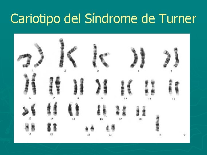 Cariotipo del Síndrome de Turner 