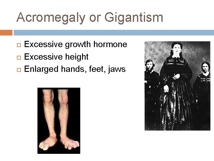 Acromegaly or Gigantism Excessive growth hormone Excessive height Enlarged hands, feet, jaws 