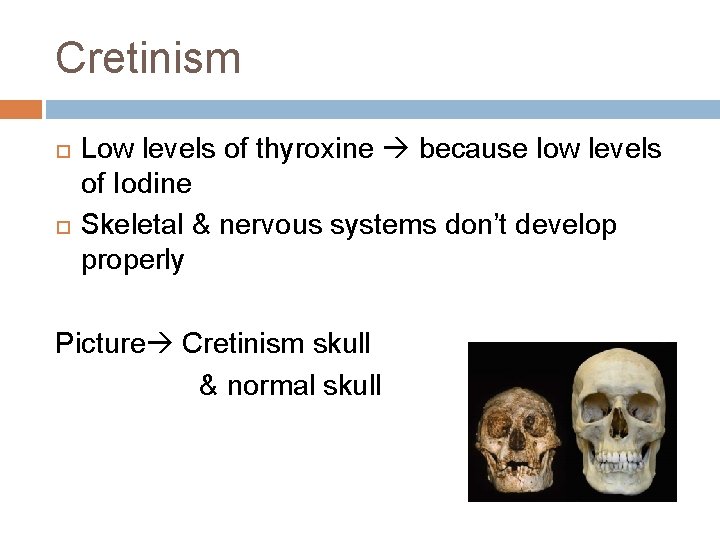 Cretinism Low levels of thyroxine because low levels of Iodine Skeletal & nervous systems