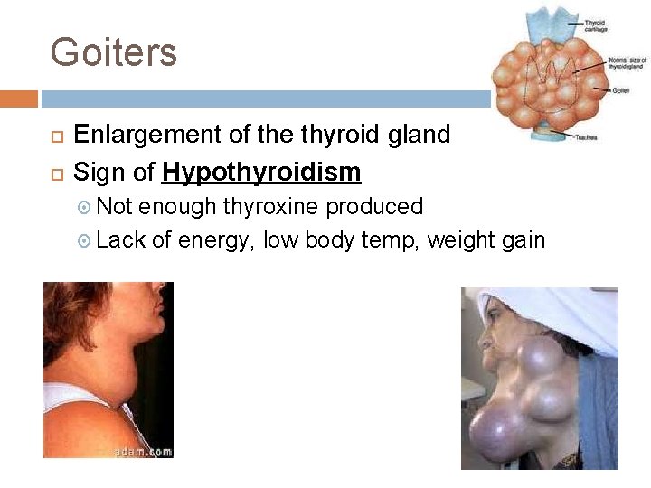 Goiters Enlargement of the thyroid gland Sign of Hypothyroidism Not enough thyroxine produced Lack