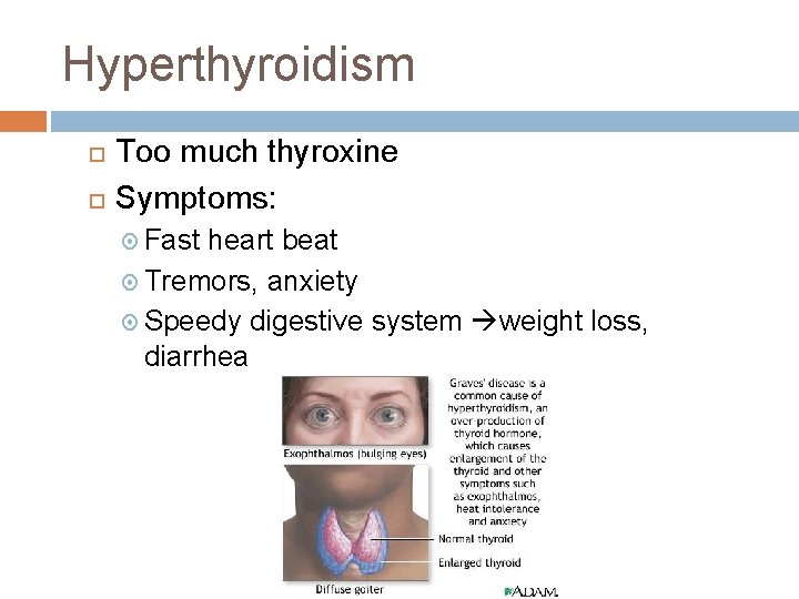 Hyperthyroidism Too much thyroxine Symptoms: Fast heart beat Tremors, anxiety Speedy digestive system weight