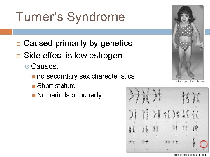 Turner’s Syndrome Caused primarily by genetics Side effect is low estrogen Causes: no secondary