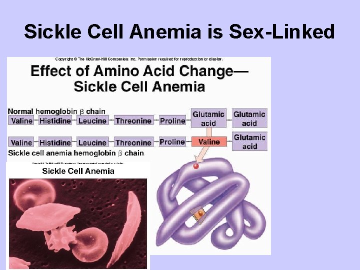 Sickle Cell Anemia is Sex-Linked 