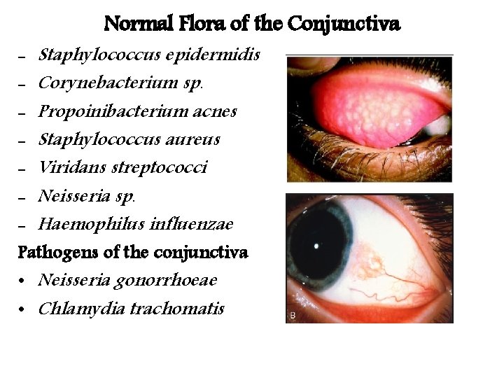 Normal Flora of the Conjunctiva - Staphylococcus epidermidis - Corynebacterium sp. - Propoinibacterium acnes