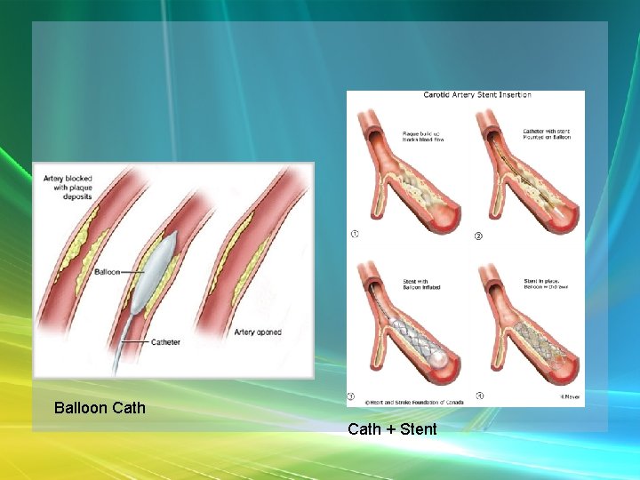 Balloon Cath + Stent 