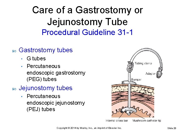 Care of a Gastrostomy or Jejunostomy Tube Procedural Guideline 31 -1 Gastrostomy tubes G