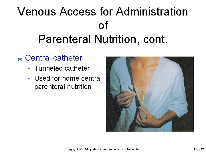 Venous Access for Administration of Parenteral Nutrition, cont. Central catheter Tunneled catheter • Used