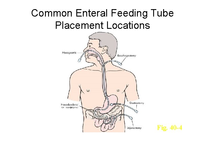 Common Enteral Feeding Tube Placement Locations Fig. 40 -4 6 