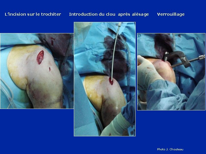 L’incision sur le trochiter Introduction du clou après alésage Verrouillage Photo J. Chouteau 