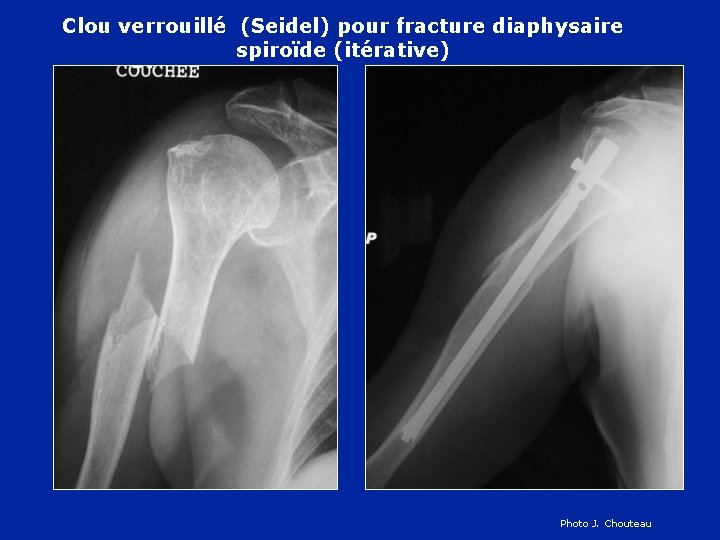 Clou verrouillé (Seidel) pour fracture diaphysaire spiroïde (itérative) Photo J. Chouteau 