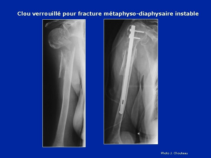 Clou verrouillé pour fracture métaphyso-diaphysaire instable Photo J. Chouteau 