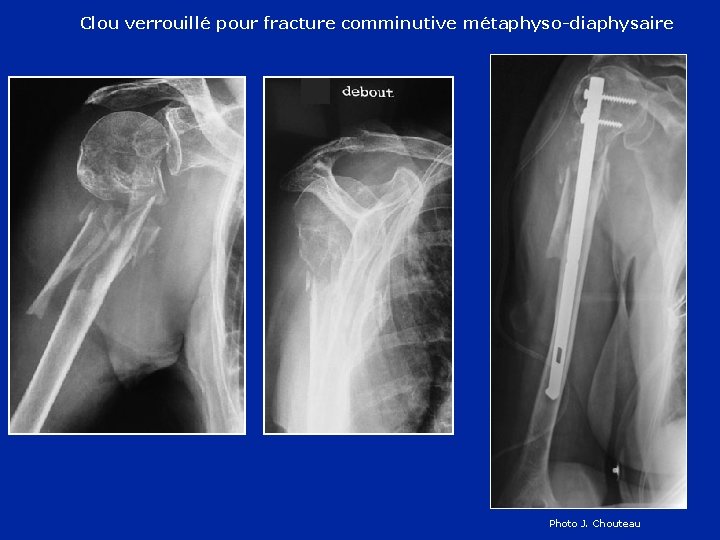Clou verrouillé pour fracture comminutive métaphyso-diaphysaire Photo J. Chouteau 