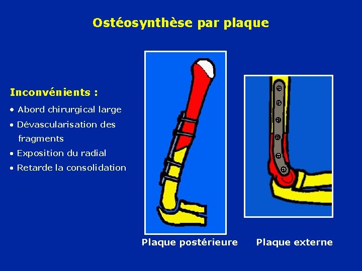 Ostéosynthèse par plaque Inconvénients : • Abord chirurgical large • Dévascularisation des fragments •
