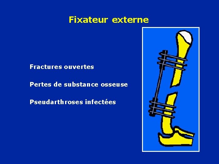 Fixateur externe Fractures ouvertes Pertes de substance osseuse Pseudarthroses infectées 