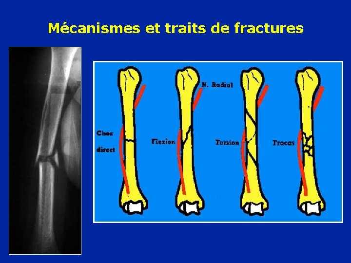 Mécanismes et traits de fractures 
