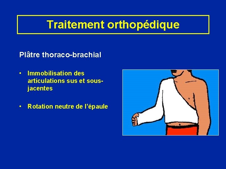 Traitement orthopédique Plâtre thoraco-brachial • Immobilisation des articulations sus et sousjacentes • Rotation neutre