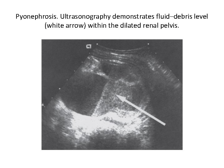 Pyonephrosis. Ultrasonography demonstrates fluid–debris level (white arrow) within the dilated renal pelvis. 