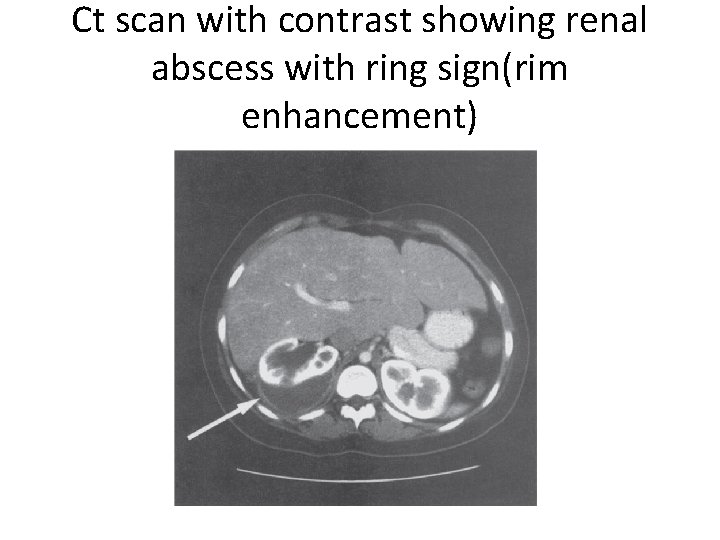 Ct scan with contrast showing renal abscess with ring sign(rim enhancement) 