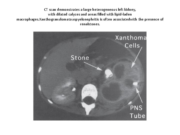 CT scan demonstrates a large heterogeneous left kidney, with dilated calyces and areas filled