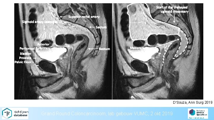 D’Souza, Ann Surg 2019 Grand Round Coloncarcinoom, lab gebouw VUMC, 2 okt 2019 