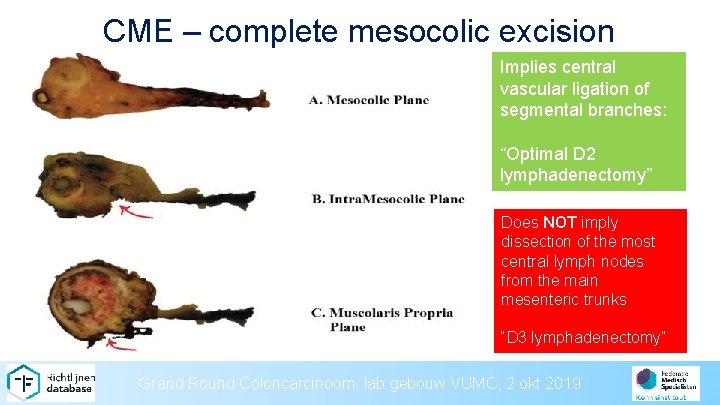 CME – complete mesocolic excision Implies central vascular ligation of segmental branches: “Optimal D