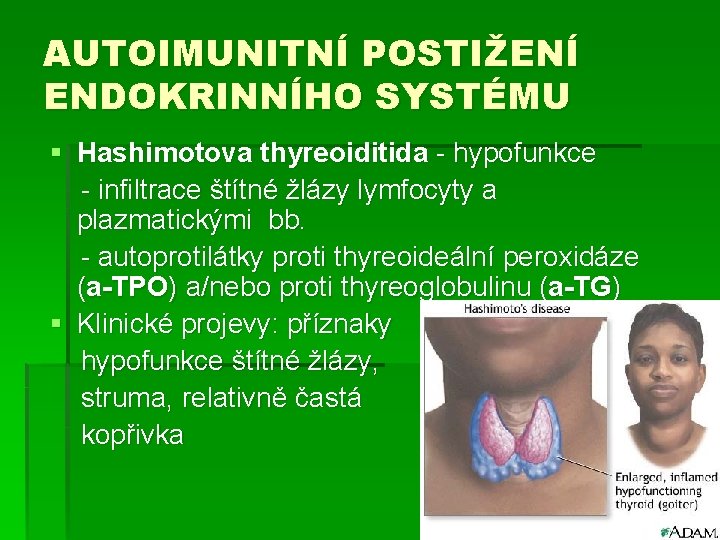 AUTOIMUNITNÍ POSTIŽENÍ ENDOKRINNÍHO SYSTÉMU § Hashimotova thyreoiditida - hypofunkce - infiltrace štítné žlázy lymfocyty