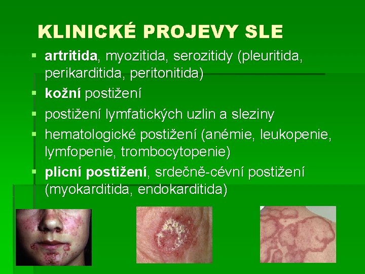 KLINICKÉ PROJEVY SLE § artritida, myozitida, serozitidy (pleuritida, perikarditida, peritonitida) § kožní postižení §
