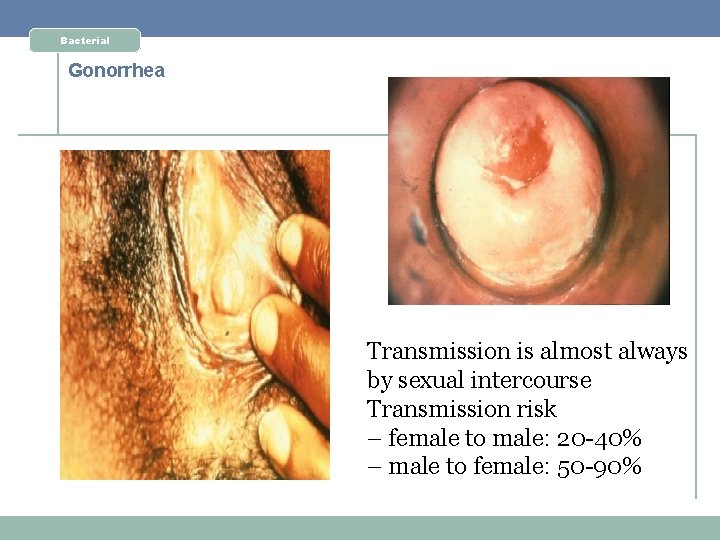 Bacterial Gonorrhea Transmission is almost always by sexual intercourse Transmission risk – female to