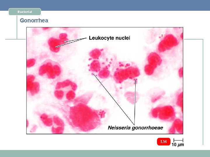 Bacterial Gonorrhea 