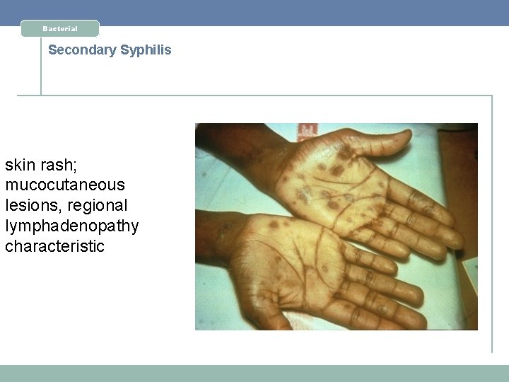 Bacterial Secondary Syphilis skin rash; mucocutaneous lesions, regional lymphadenopathy characteristic 
