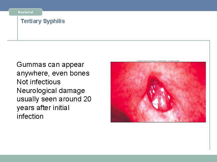 Bacterial Tertiary Syphilis Gummas can appear anywhere, even bones Not infectious Neurological damage usually