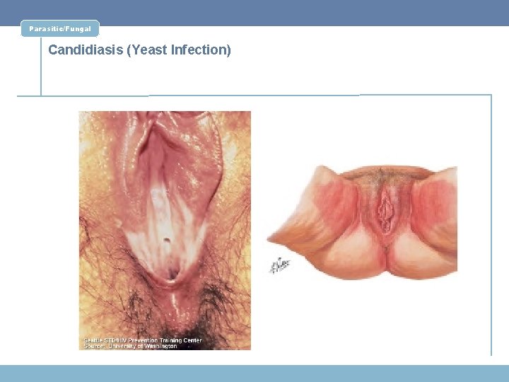 Parasitic/Fungal Candidiasis (Yeast Infection) 