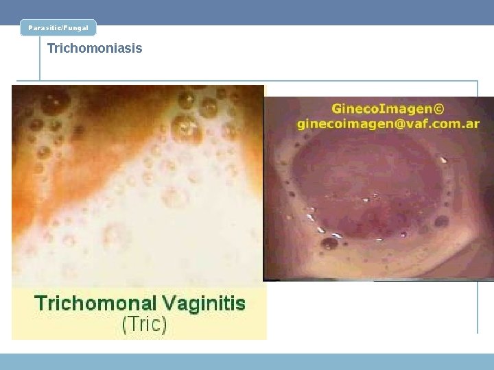 Parasitic/Fungal Trichomoniasis 