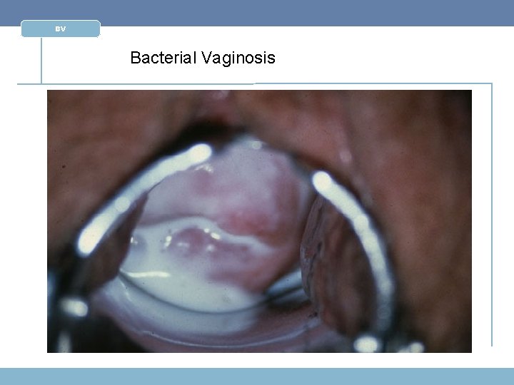 BV Bacterial Vaginosis 