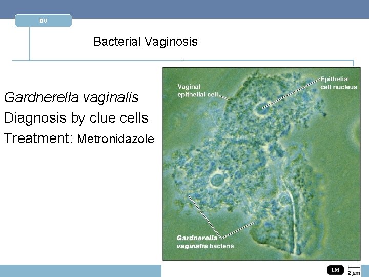 BV Bacterial Vaginosis Gardnerella vaginalis Diagnosis by clue cells Treatment: Metronidazole 