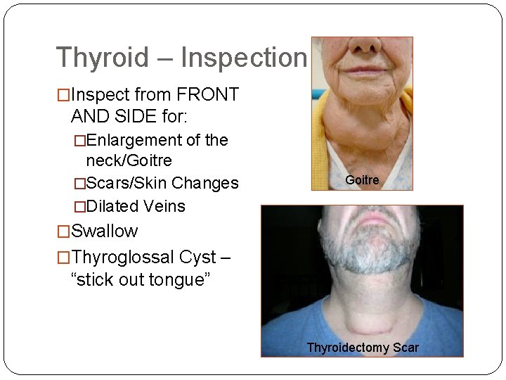 Thyroid – Inspection �Inspect from FRONT AND SIDE for: �Enlargement of the neck/Goitre �Scars/Skin