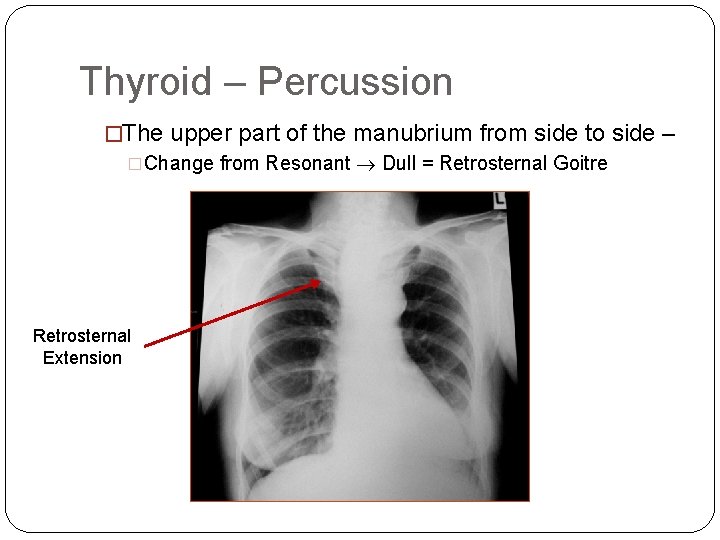 Thyroid – Percussion �The upper part of the manubrium from side to side –