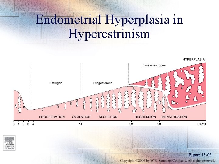 Endometrial Hyperplasia in Hyperestrinism Figure 15 -05 