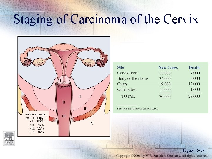 Staging of Carcinoma of the Cervix Figure 15 -07 