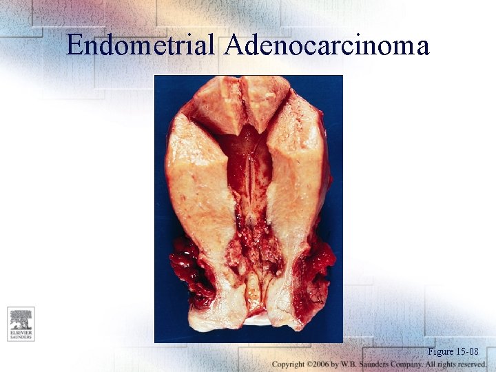 Endometrial Adenocarcinoma Figure 15 -08 